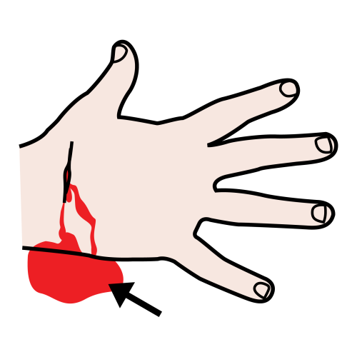 Fig.1.4. Sangre. Sergio Palao. ARASAAC. CC BY-NC-SA