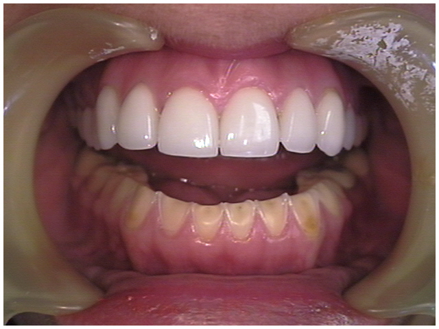 Fig.4.5. Manifestaciones orales de la Bulimia. DentalSchoolProf. Wikimedia Commons. CC BY-NC-SA
